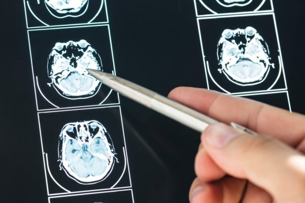 Three Things You Need to Know if You Have a Concussion