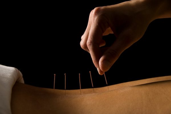 Sports Medicine Acupuncture