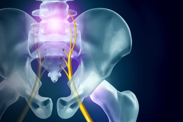 Active Release Therapy for Sciatica