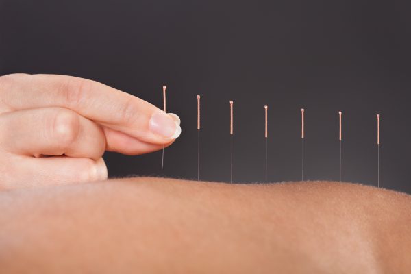 Acupuncture for Stress Relief